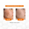 KLEANSE Glowhite Intensive Pigment Correctaor Serum Reduce Melasma Acne Marks Pimple Scars