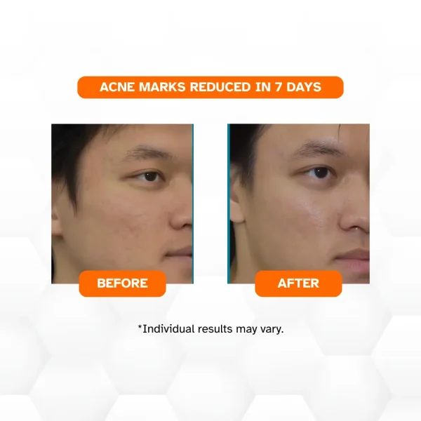 3 KLEANSE Niacinamide Mandelic Acid Serum Refine Skin Texture Repair Acne Marks Pimple Scars Pigments 20ml