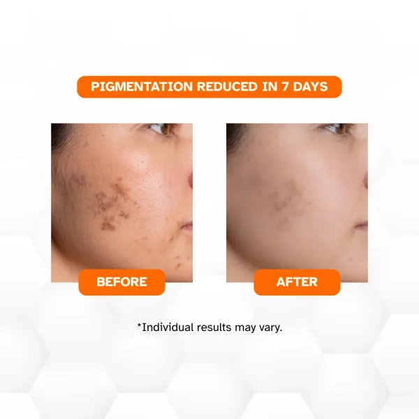 KLEANSE Glowhite Intensive Pigment Correctaor Serum Reduce Melasma Acne Marks Pimple Scars