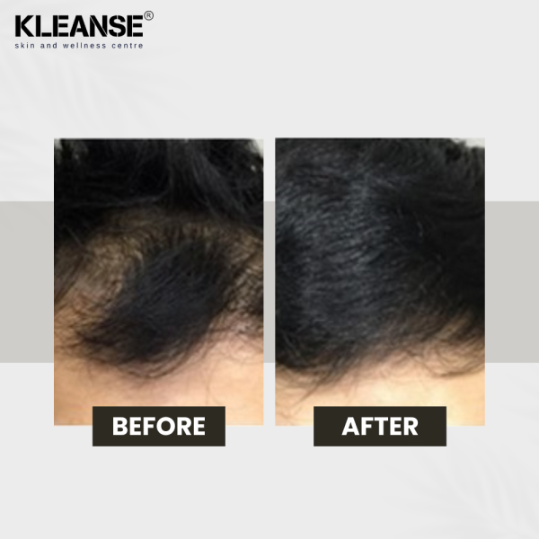 KLEANSE Cabello Hair Tonic Daily Hair Loss Spray Anti Hair Fall Treatment Anti Dandruff