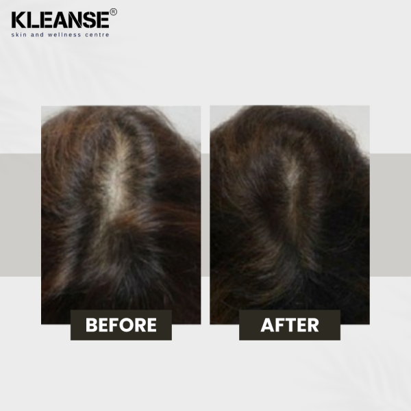 KLEANSE Cabello Hair Tonic Daily Hair Loss Spray Anti Hair Fall Treatment Anti Dandruff
