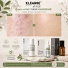 KLEANSE Acne Skin Solution Kit To Treat Acne Prone Pimple Skin Repair Soothe Clarify